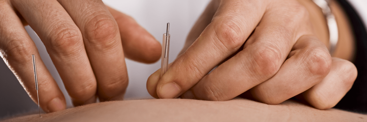 Acupuncture